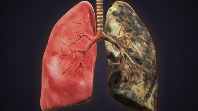 bệnh phổi